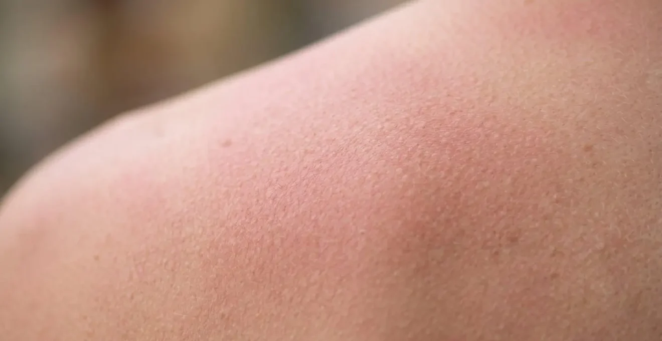 Gros plan sur texture de peau avec rougeur subtile illustrant les effets d'une brulure solaire legere